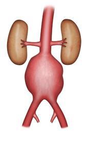 Anévrisme de l'Aorte Abdominale | Société de Chirurgie Vasculaire ...